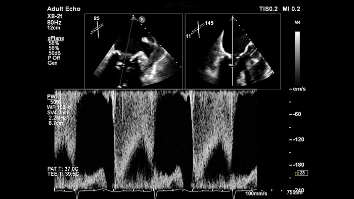 EPIQ CVx – xPlane Doppler