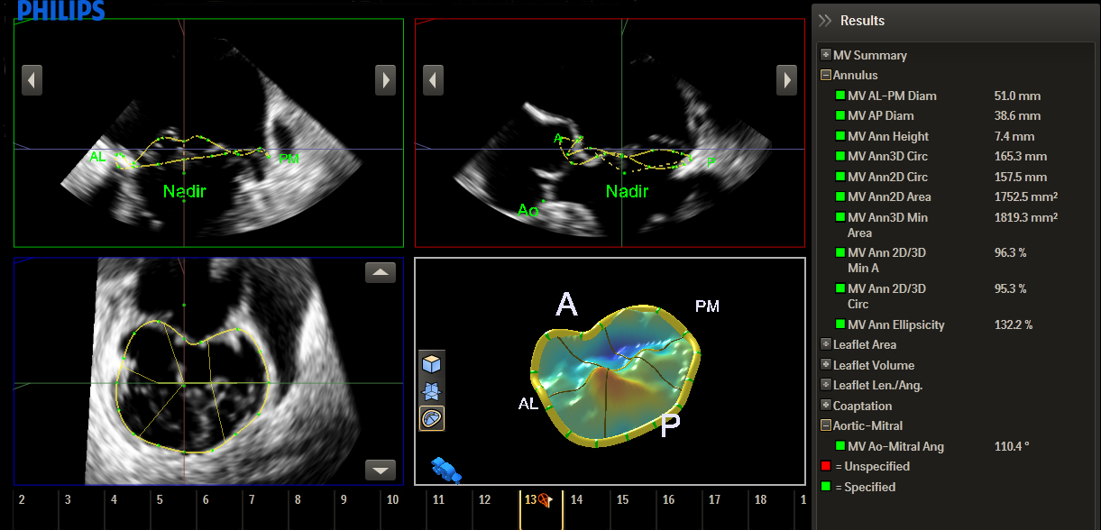 Mitralklappen-Messungen und &ndash;Berechnungen mit anatomischer Intelligenz beim Ultraschall​