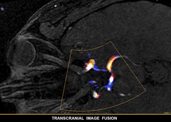 Transkranielle Bildfusion f&uuml;r die Kombination von Modalit&auml;ten mit Live-Ultraschall​
